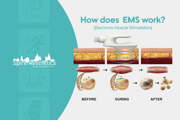 EMS treatment for post pregnancy weight loss treatment Maidenhead