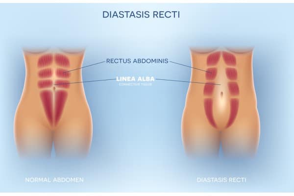 What Non-Surgical Options Are Available for Diastasis Recti Maidenhead?