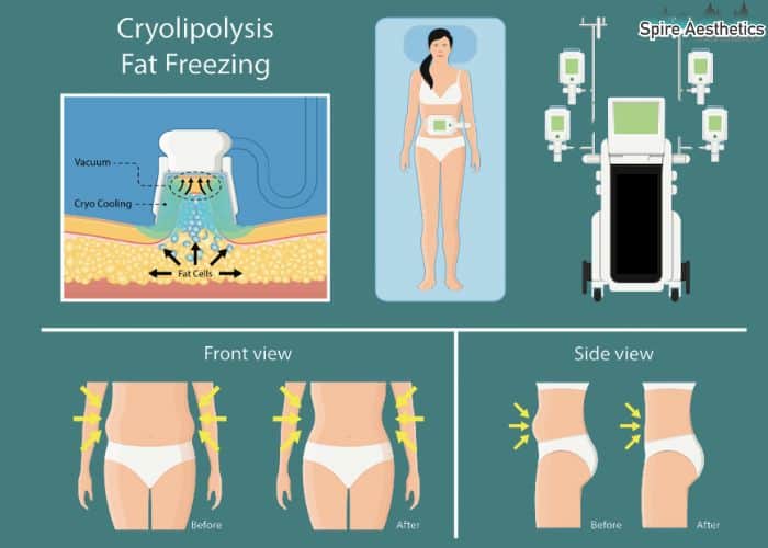 Image of diet and fat freezing combined for best results for Spire Aesthetics Maidenhead