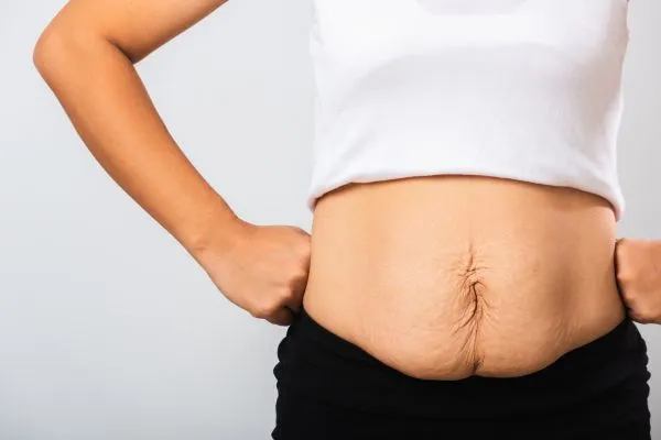 Image of a woman's stomach after weight loss with sagging skin following a gastric band Maidenhead