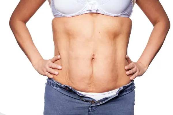 sagging skin on woman's stomach after weight loss injections Maidenhead
