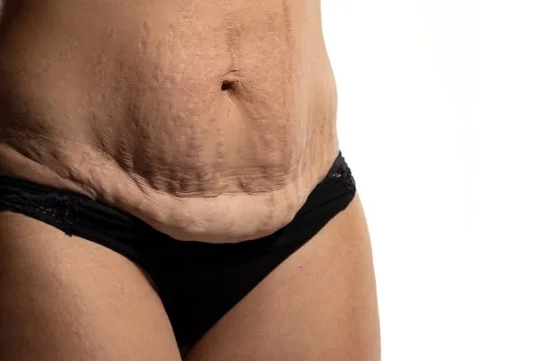Image of womans stomach after weight loss injections Maidenhead showing saggy skin