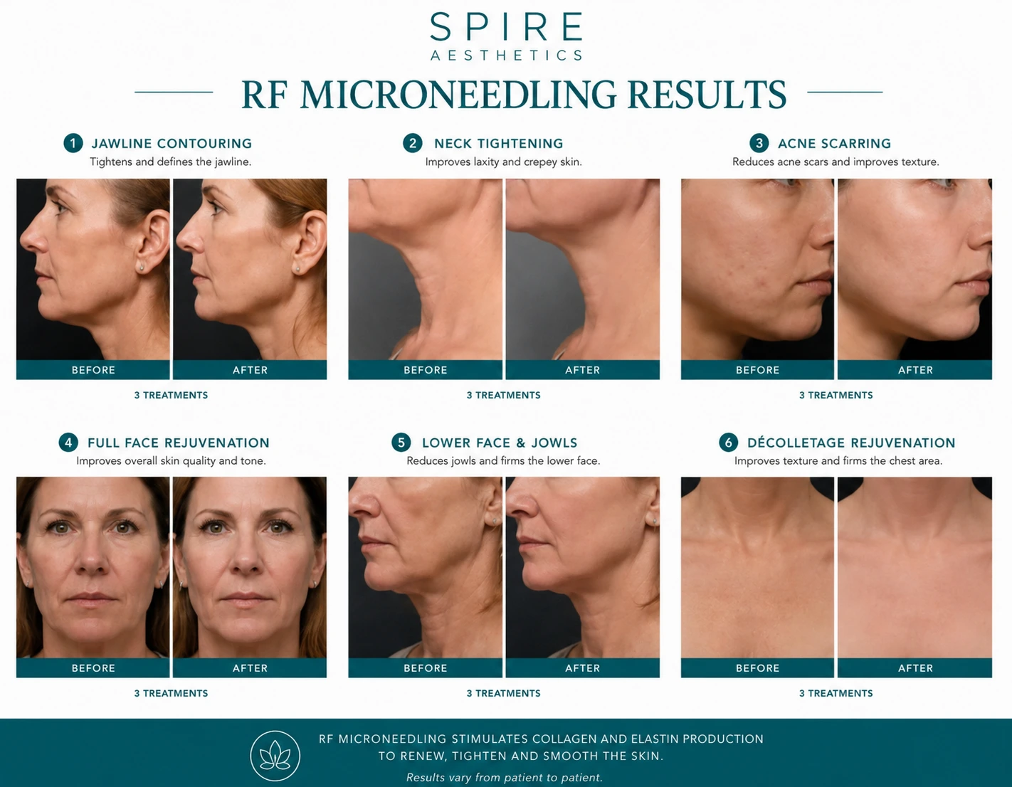 RF Microneedling Skin tightening Maidenhead results