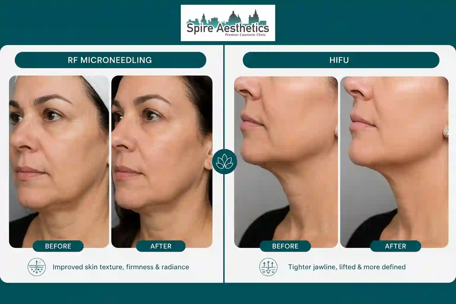 Can RF Microneedling and HIFU Be Combined Maidenhead?
