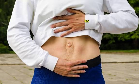 When Could Diastasis Recti Be the Missing Piece of the Puzzle Maidenhead?