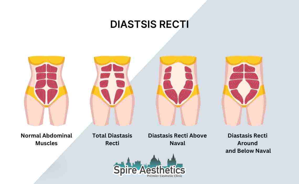 Is Non-Surgical Diastasis Recti Treatment Right for You? Common Concerns Answered Maidenhead